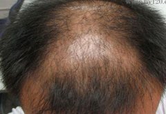 遗传性脱发怎么治疗