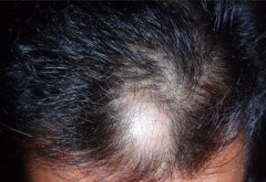 化学性脱发患者需要注意什么