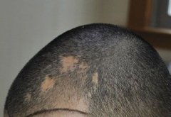 头上有疤痕可以做植发吗